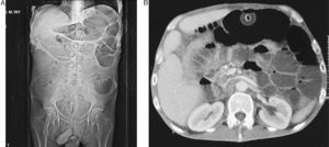 a y b Tomografía computarizada abdominal del paciente en la que se aprecia la sonda de gastrostomía y la distensión de asas de intestino delgado.
