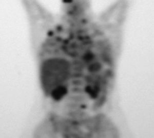 A whole body positron emission tomography performed in 2008 revealed a pulmonary hypermetabolic nodule 25mm in diameter in the right upper lobe; several smaller nodules in the right lower lobe; invasion of the left supraclavicular, mediastinal, hilar, and subcarinal lymph nodes; a paraaortic retroperitoneal mass; and multiple focal bone lesions.