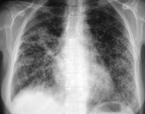Chest X-rays of the patient upon admission showed bilateral micronodular lung infiltrates with coalescent areas between them, giving consolidation images.
