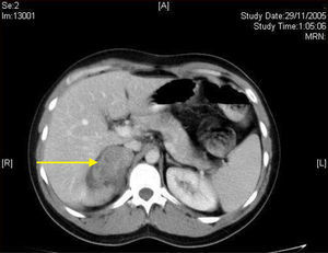 Imagen de TC en la que se observa una masa sólida hipoatenuada y ovalada en la glándula suprarrenal derecha.