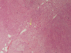 Células ganglionares maduras formando pequeños grupos y nidos (flecha) con un estroma neuromatoso, creciendo sobre tejido suprarrenal normal.