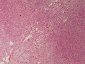 Células ganglionares maduras formando pequeños grupos y nidos (flecha) con un estroma neuromatoso, creciendo sobre tejido suprarrenal normal.