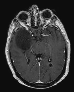 Corte axial de la resonancia magnética cerebral, que muestra un gran tumor en la sustancia blanca del lóbulo temporal derecho. El tumor no genera edema vasogénico, pero provoca colapso parcial del ventrículo lateral derecho. También se visualiza el meningioma calcificado en el asta occipital del ventrículo lateral izquierdo.