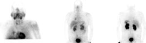 Gammagrafia de receptores de somatostatina, imágenes planares de cabeza, tórax y abdomen a las 4 y 24 horas. En las imágenes planares se detectan dos lesiones nodulares con elevada densidad de receptores de somatostatina en hemitórax derecho y por delante del plano inferior del bazo.