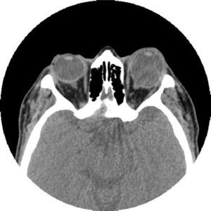 TC de órbitas: Aumento de los diámetros del globo ocular izquierdo, con ligera deformidad del borde pósterolateral de la esclera, compatible con macroftalmía asociada a estafiloma, evidenciándose un leve-moderado engrosamiento de los músculos extraoculares del globo ocular izquierdo.