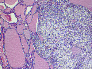 Fóliculos tiroideos rodeados de células tumorales.