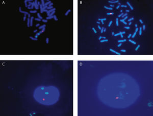 FISH realizada con sonda centromérica para el cromosoma X (rojo) y el cromosoma Y (verde). A y B: metafases, C y D: núcleos. A: metafase con 2 señales verdes (2 centómeros de cromosoma Y) y una señal roja (un centrómero del cromosoma X), B: metafase con una señal roja (un centrómero del cromosoma X) C: núcleo con 2 señales verdes (2 centrómeros del cromosoma Y) y una señal roja (un centrómero del cromosoma X), D: metafase con una señal roja (un centrómero del cromosoma X).