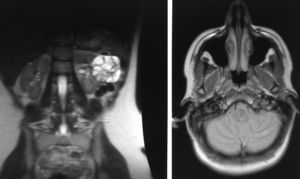 2A) RM abdominal axial. Tumoración quística heterogénea en riñón izquierdo, de 7,6×6,2cm de diámetro. 2B) RM cerebral. Lesiones hipercaptantes, situadas en el hemisferio cerebeloso izquierdo, una de unos 5mm y la otra más periférica de 3mm, que corresponden a pequeños hemangioblastomas cerebelosos.