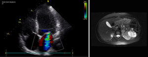 1A)Ecocardiografía transtorácica (plano apical 4C). Insuficiencia mitral. 1B) RM abdominal corte transversal. Masa suprarrenal izquierda de 2,3cm de diámetro bien delimitada sugestiva de feocromocitoma (señalada con flecha roja).