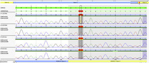 Electrophoretogram of the exon 3–intron 3 transition, highlighting the mutation detected.