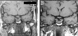 RM hipofisaria. Corte coronal en T1 sin constraste mostrando estabilidad del adenoma hipofisario antes (A) y después (B) de la gestación