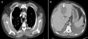 Imágenes de tomografía computerizada toraco-abdominal inicial: A) Derrame pleural izquierdo (flecha), lesiones nodulares pulmonares. B) Absceso hepático en lóbulo hepático izquierdo, segmento 3 (flecha).