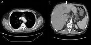 Imágenes de tomografía computerizada toraco-abdominal tras drenaje del absceso y tratamiento antibiótico: A) Mejoría de nódulos pulmonares y ausencia de derrame pleural. B) Reducción significativa del absceso (flecha).