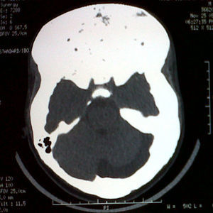 Imagen de tomografía computarizada del paciente descrito en que se observa un aumento de volumen de la masa ósea en bóveda craneana y estructuras de la región frontal, orbitaria y mastoidea compatibles con displasia fibrosa.