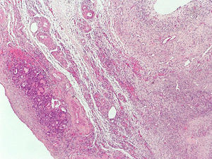 Imagen histológica del struma ovárico en ovario derecho.