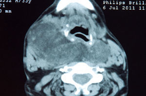 TC cervical (ver texto).