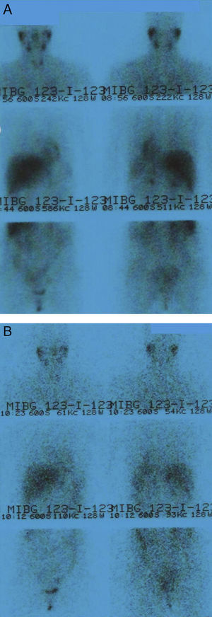 Gammagrafía con 123I-MIBG (dosis de 185 MBq). Proyecciones anterior y posterior de cuello-tórax-abdomen a las 24 h (A) y anterior y posterior de cuello-tórax-abdomen a las 48 h (B). No se observan hallazgos patológicos. Las imágenes obtenidas muestran una distribución del radiofármaco compatible con la distribución fisiológica desde las primeras adquisiciones.