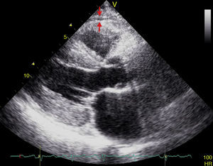 Medición ecocardiográfica del espesor del tejido adiposo epicárdico en eje paraesternal largo. La grasa epicárdica se identifica como el espacio (entre flechas) entre la pared externa del miocardio y la capa visceral del pericardio.