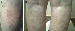 a y b. Granuloma anular.