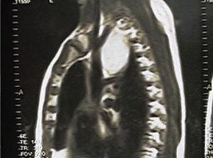 RM de tórax prequirúrgica donde se observa una imagen en el mediastino superior posterior.