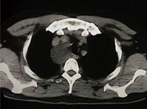 RM de tórax prequirúrgica donde se observa una imagen en el mediastino superior posterior.