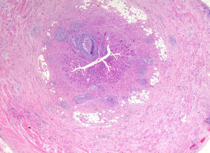 Infiltración transmural por pequeños nidos de células, ocasionalmente con morfología en anillo de sello, acompañada de una apendicitis aguda (HE×20).