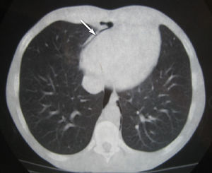 Imagen de una tomografía computarizada a nivel de las cavidades cardiacas donde se visualiza aire anterior al corazón por neumopericardio (flecha).