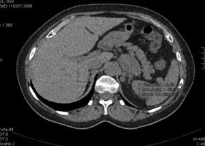Sección transversal de tomografía computarizada que muestra la lesión adrenal izquierda, con tamaño > 4cm y atenuación > 10 UH. Ambos datos son orientativos de causas malignas de incidentaloma adrenal, pero este caso es una excepción importante a esta regla.