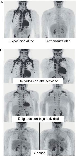 Distribución y actividad del TAM en humanos detectada mediante tomografía por emisión de positrones (PET) con 18F-FDG. A)Incremento de la actividad del TAM en un individuo delgado expuesto a baja temperatura (16¿C) o en condiciones de termoneutralidad. B)Actividad del TAM en individuos delgados y obesos expuestos a baja temperatura (16¿C).Fuente: Van Marken Lichtenbelt et al.25