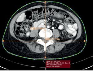 Evaluation of the waist circumference on a CT image, using both a line to approximate the skin contour and calculating the anterior–posterior and transverse abdominal diameters.