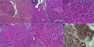 A. Tumor tiroideo con patrón bifásico de carcinoma papilar (CP) y carcinoma escamoso (CE). A la izquierda se advierte un patrón folicular del CP y a la derecha un patrón sólido del CE (×20). B. La misma imagen de (A) a mayor aumento (×20). C. Patrón folicular del carcinoma papilar. D y E. Zonas de diferenciación escamosa atípica. F. Fuerte positividad inmunohistoquímica para la citoqueratina 19 tanto en las áreas de CP como de CE.