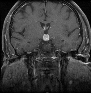Resonancia magnética nuclear cráneo potenciada en T1 con contraste. Se aprecian 2 lesiones intraaxiales bien definidas: una a nivel de cuerpos mamilares e hipotálamo y otra a nivel del pedúnculo cerebeloso medio izquierdo.