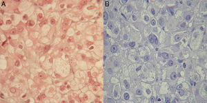 Tumor de células esteroides: grandes células poligonales con citoplasma vacuolado. A) Tricómico. B) H & E.
