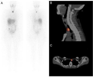Post-therapy I-131 focal tracer uptake in the upper mediastinum (A). Chest SPECT/CT (sagittal plane) shows low-intensity tracer uptake in upper mediastinum (B). Chest SPECT/CT (transversal plane) tracer uptake in thymus gland (C).