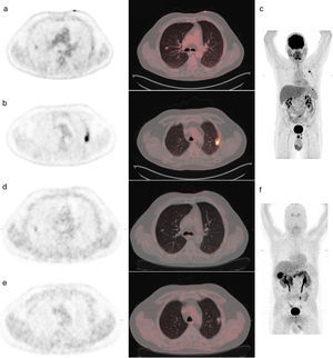 Upper panel. 18F-FDG-PET/CT performed after the injection of 259MBq of radiotracer. (a) Pulmonary nodule located in the right-upper-lobe with SUVmax 1.9. (b) A second pleural-based pulmonary nodule was located in the left-upper-lobe with SUVmax 10.3. (c) Maximum intensity projection of 18F-FDG-PET/CT scan. Lower panel. 18F-DOPA-PET/CT acquired after the injection of a dose of 233MBq. (d) Solitary pulmonary node showed in the right-upper-lobe with SUVmax 1.1. (e) 18F-DOPA-PET/CT allowed discarding the contralateral and pleural involvement. (f) Maximum intensity projection of 18F-DOPA-PET/CT scan revealing pancreatic physiological uptake due to no administration of carbidopa before the injection of radiotracer.