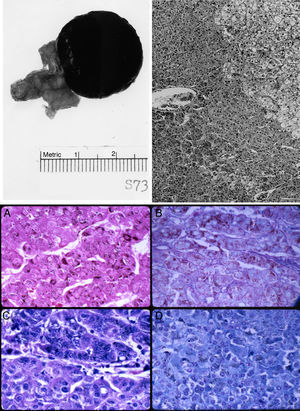 Top left: gross photograph of the black adrenal adenoma with atrophic adrenal seen in the adipose tissue to the left. Top right: margin of zona reticularis with pigmented tumor cells below and to the left. Hematoxylin and eosin. Magnification, 120×. Bottom: lipofuscin pigments as stained by (A) Fontana; (B) Alcian blue-PAS; (C) Giemsa; and (D) Luxol fast blue. Magnification, 480×.