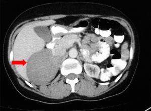 CT showing a right adrenal mass.