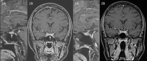Pituitary MRI images of the ACTH-producing tumor before (Figure 1A and B) and after (Figure 2A and B) 9 months under cabergoline treatment, showing a complete resolution of the lesion.