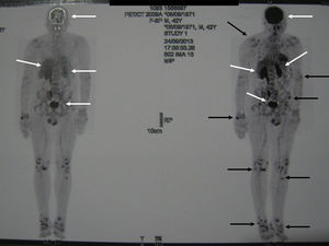 FDG-PET/CT en paciente con osteomalacia oncogénica. Se observan múltiples focos hipermetabólicos en áreas de pseudofracturas (flechas negras). Nótese la captación fisiológica en encéfalo, hígado, bazo y vías urinarias (flechas blancas).