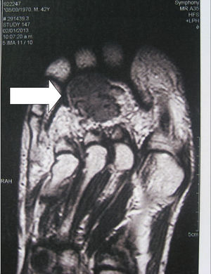 Tumor mesenquimal fosfatúrico de localización plantar. La RNM muestra una lesión heterogénea de baja intensidad, bordes irregulares, de 2×3cm aproximadamente.