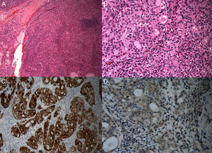 Anatomía patológica de tumor: A y B) Hematoxilina-eosina; C) Positivo para citoqueratina 20+, y D) Negativo para TTF-1.