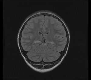 Corte coronal FLAIR con aumento de la señal temporal medial bilateral.