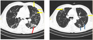 COVID-19 pneumonia: CT scan shows bilateral ground-glass opacity (yellow arrows), consolidation (red arrow), and reticular opacities (blue arrows). (For interpretation of the references to color in this figure legend, the reader is referred to the web version of this article.)