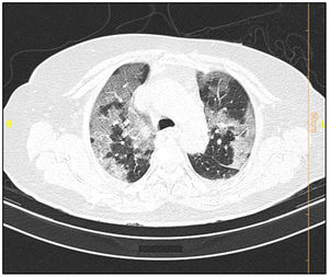 COVID-19 pneumonia: CT scan shows crazy paving pattern.