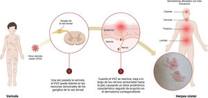 Infografía sobre la primoinfección-latencia-reactivación del virus varicela zóster (VVZ). 1) Una vez que el episodio de varicela ha terminado, el VVZ permanece latente en las neuronas sensoriales de los ganglios de la raíz dorsal. 2) Cuando el VVZ se reactiva, viaja a lo largo de los nervios sensoriales hasta la piel causando dolor prodrómico característico seguido de erupción en el dermatoma correspondiente.