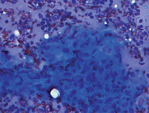 Visión citológica de adenopatía subcarinal con granulomas sarcoideos.
