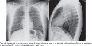 Radiografía posteroanterior y lateral de tórax en la que se observa un infiltrado reticulonodular bilateral de localización predominante en los campos pulmonares medios y superiores.