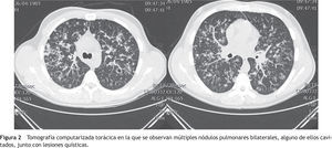 Tomografía computarizada torácica en la que se observan múltiples nódulos pulmonares bilaterales, alguno de ellos cavitados, junto con lesiones quísticas.