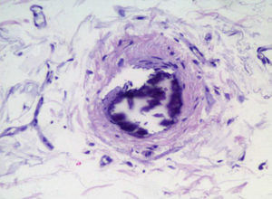 Biopsia de la piel: tinción de hematoxilina-eosina. Revisión. Necrosis cutánea progresiva a partir de la calcificación de la capa media de las pequeñas arteriolas.