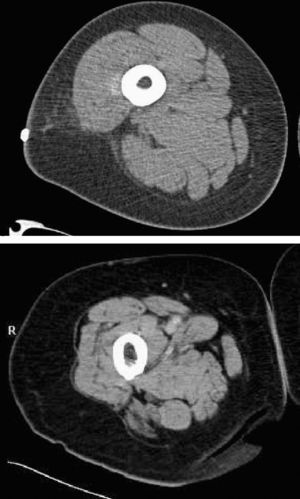 Imagen de dos cortes de resonancia magnética nuclear correspondientes a una mujer joven y a otra anciana con índices de masa corporal similares, donde se observa la diferente relación entre el tejido muscular y graso.